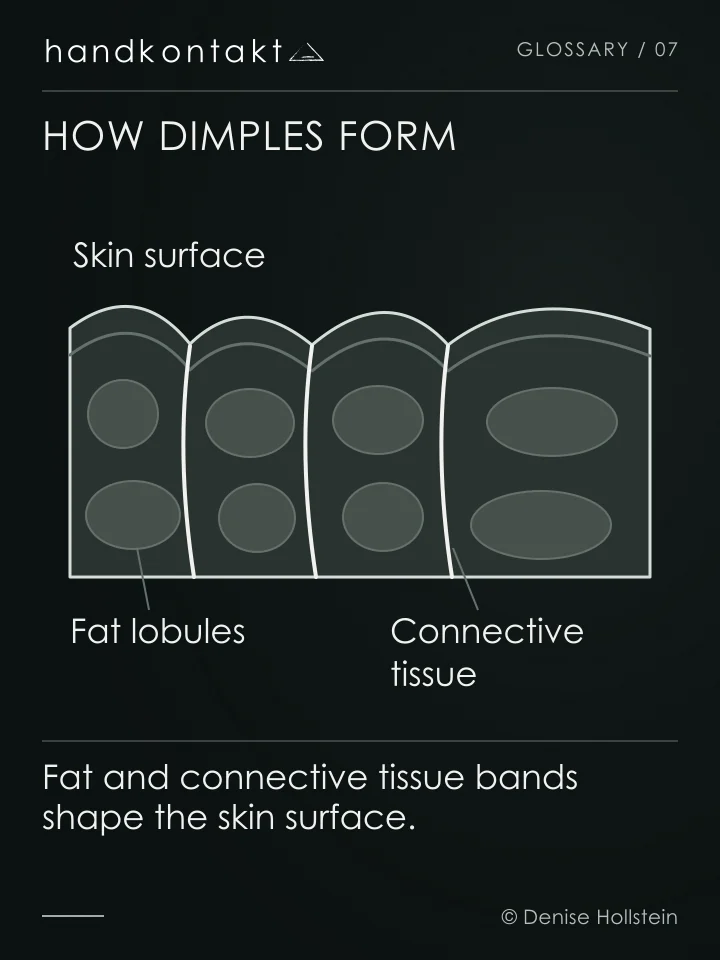 Fat lobules sit between connective tissue bands beneath the skin. Their volume and the pull of the bands can create dimples. Massage does not permanently remove these structures.