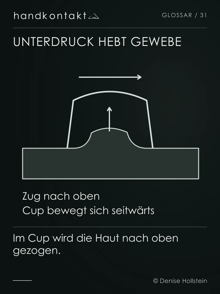 Ein Cup hebt die Haut durch Unterdruck an. Der senkrechte Pfeil zeigt den Zug, der waagerechte Pfeil die Bewegung des Cups auf der Haut.